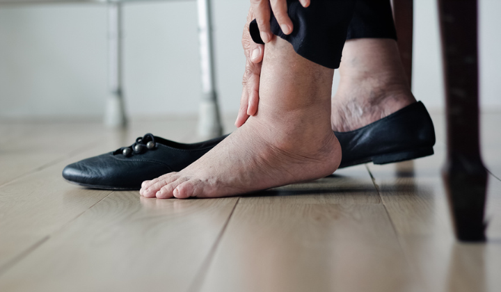 Frau mit geschwollenen Füßen